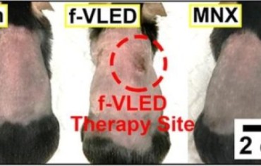 Un dispositivo portátil para hacer volver a crecer el cabello.