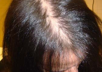 Tipos de alopecia androgenética femenina