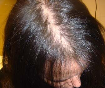 Tipos de alopecia androgenética femenina
