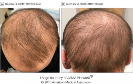 Medicamento eccema restaura crecimiento en paciente con alopecia de larga duración