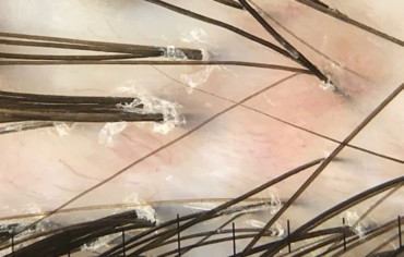 Tricoscopia: Método para el diagnóstico de la alopecia