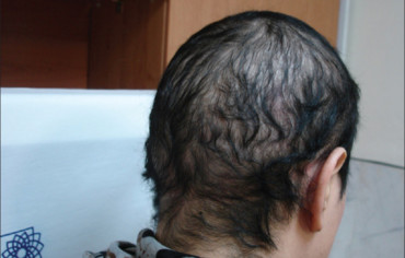 Nuevo gen identificado responsable de un tipo de alopecia – Hipotricosis simple