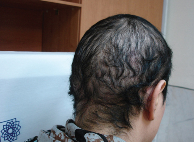 Nuevo gen identificado responsable de un tipo de alopecia – Hipotricosis simple
