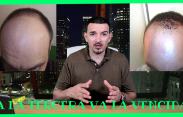 2 OPERACIONES DE TRASPLANTE CAPILAR Y CAMINO DE UN TERCER INJERTO