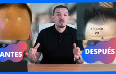 RESULTADO INJERTO CAPILAR 4.600 FOLÍCULOS CLINICA ERCILLA DR JOSE LOZA