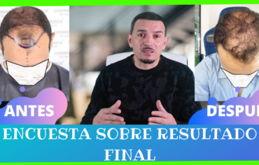 12 MESES POST INJERTO CAPILAR EN CLINICA COSMEDICA DR. LEVEN ACAR